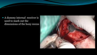  A dummy internal receiver is
used to mark out the
dimensions of the bony recess
 