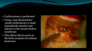  Cochleostomy is performed
 Using 1 mm diamond bur
,small cochleostomy is made
immediately anterior and
inferior to the round window
membrane
 This allows direct access to
the Scala tympani of cochlear
basal turn.
 