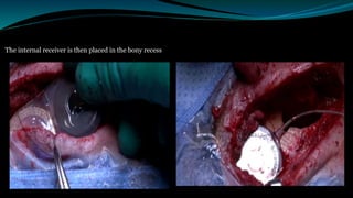 The internal receiver is then placed in the bony recess
 