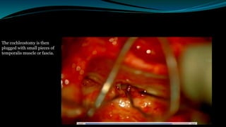The cochleostomy is then
plugged with small pieces of
temporalis muscle or fascia.
 