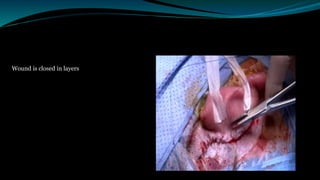 Wound is closed in layers
 