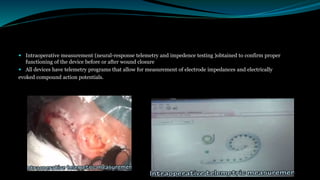  Intraoperative measurement (neural-response telemetry and impedence testing )obtained to confirm proper
functioning of the device before or after wound closure
 All devices have telemetry programs that allow for measurement of electrode impedances and electrically
evoked compound action potentials.
 