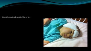 Mastoid dressing is applied for 24 hrs
 