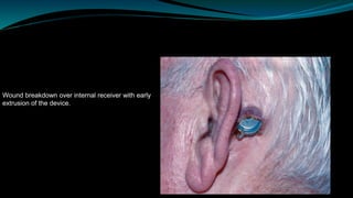 Wound breakdown over internal receiver with early
extrusion of the device.
 