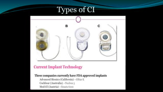 Types of CI
 