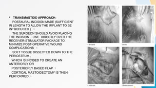 COCHLEAR IMPLANT cochlea inner ear ent.pptx