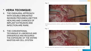 COCHLEAR IMPLANT cochlea inner ear ent.pptx