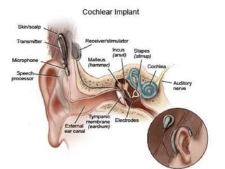 Cochlear ltd case study strategic management by jack ng | PPTX