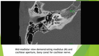 Mid-modiolar view demonstrating modiolus (M) and
cochlear aperture, bony canal for cochlear nerve.
 