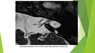 Cochleovestibular nerve (CVN) entering common cavity (CC).
 