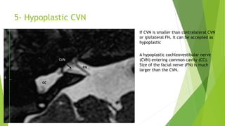 5- Hypoplastic CVN
If CVN is smaller than contralateral CVN
or ipsilateral FN, it can be accepted as
hypoplastic
A hypoplastic cochleovestibular nerve
(CVN) entering common cavity (CC).
Size of the facial nerve (FN) is much
larger than the CVN.
 