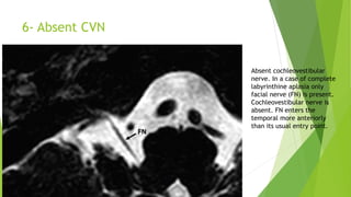 6- Absent CVN
Absent cochleovestibular
nerve. In a case of complete
labyrinthine aplasia only
facial nerve (FN) is present.
Cochleovestibular nerve is
absent. FN enters the
temporal more anteriorly
than its usual entry point.
 