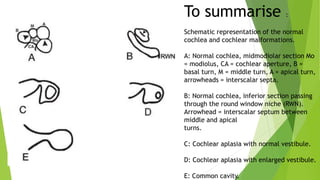To summarise :
Schematic representation of the normal
cochlea and cochlear malformations.
A: Normal cochlea, midmodiolar section Mo
= modiolus, CA = cochlear aperture, B =
basal turn, M = middle turn, A = apical turn,
arrowheads = interscalar septa.
B: Normal cochlea, inferior section passing
through the round window niche (RWN).
Arrowhead = interscalar septum between
middle and apical
turns.
C: Cochlear aplasia with normal vestibule.
D: Cochlear aplasia with enlarged vestibule.
E: Common cavity.
 