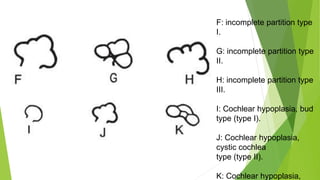 F: incomplete partition type
I.
G: incomplete partition type
II.
H: incomplete partition type
III.
I: Cochlear hypoplasia, bud
type (type I).
J: Cochlear hypoplasia,
cystic cochlea
type (type II).
K: Cochlear hypoplasia,
 