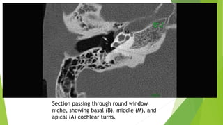 Section passing through round window
niche, showing basal (B), middle (M), and
apical (A) cochlear turns.
 