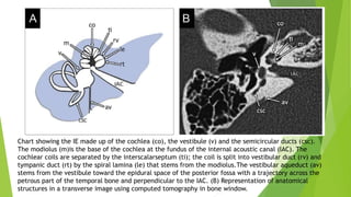 Chart showing the IE made up of the cochlea (co), the vestibule (v) and the semicircular ducts (csc).
The modiolus (m)is the base of the cochlea at the fundus of the internal acoustic canal (IAC). The
cochlear coils are separated by the interscalarseptum (ti); the coil is split into vestibular duct (rv) and
tympanic duct (rt) by the spiral lamina (le) that stems from the modiolus.The vestibular aqueduct (av)
stems from the vestibule toward the epidural space of the posterior fossa with a trajectory across the
petrous part of the temporal bone and perpendicular to the IAC. (B) Representation of anatomical
structures in a transverse image using computed tomography in bone window.
 