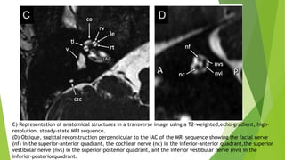 C) Representation of anatomical structures in a transverse image using a T2-weighted,echo-gradient, high-
resolution, steady-state MRI sequence.
(D) Oblique, sagittal reconstruction perpendicular to the IAC of the MRI sequence showing the facial nerve
(nf) in the superior-anterior quadrant, the cochlear nerve (nc) in the inferior-anterior quadrant,the superior
vestibular nerve (nvs) in the superior-posterior quadrant, ant the inferior vestibular nerve (nvi) in the
inferior-posteriorquadrant.
 