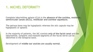 1. MICHEL DEFORMITY
Complete labyrinthine aplasia (CLA) is the absence of the cochlea, vestibule,
semicircular canals (SCCs), vestibular and cochlear aqueducts.
The petrous bone may be hypoplastic whereas the otic capsule may be
hypoplastic or aplastic
In the majority of patients, the IAC consists only of the facial canal and the
labyrinthine, tympanic and mastoid segments of the facial nerve can be
identified in the temporal bone.
Development of middle ear ossicles are usually normal.
 