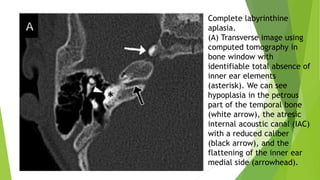 Complete labyrinthine
aplasia.
(A) Transverse image using
computed tomography in
bone window with
identifiable total absence of
inner ear elements
(asterisk). We can see
hypoplasia in the petrous
part of the temporal bone
(white arrow), the atresic
internal acoustic canal (IAC)
with a reduced caliber
(black arrow), and the
flattening of the inner ear
medial side (arrowhead).
 