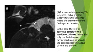 (B)Transverse image using T2-
weighted, echo-gradient,
steady-state MRI sequence
where the aforementioned
findings can be seen;
in this case there is an
absolute deficit of the
vestibulocochlear nerve and
only the facial nerve
(arrowhead) can be seen in
the cerebellopontine angle
cistern and the IAC.
 