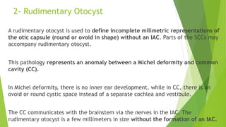 2- Rudimentary Otocyst
A rudimentary otocyst is used to define incomplete milimetric representations of
the otic capsule (round or ovoid in shape) without an IAC. Parts of the SCCs may
accompany rudimentary otocyst.
This pathology represents an anomaly between a Michel deformity and common
cavity (CC).
In Michel deformity, there is no inner ear development, while in CC, there is an
ovoid or round cystic space instead of a separate cochlea and vestibule.
The CC communicates with the brainstem via the nerves in the IAC. The
rudimentary otocyst is a few millimeters in size without the formation of an IAC.
 