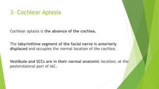 3- Cochlear Aplasia
Cochlear aplasia is the absence of the cochlea.
The labyrinthine segment of the facial nerve is anteriorly
displaced and occupies the normal location of the cochlea.
Vestibule and SCCs are in their normal anatomic location; at the
posterolateral part of IAC.
 