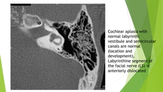 Cochlear aplasia with
normal labyrinth:
vestibule and semicircular
canals are normal
(location and
development),
Labyrinthine segment of
the facial nerve (LS) is
anteriorly dislocated
 