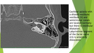 Cochlear aplasia with
a dilated vestibule:
vestibule (V) and
semicircular canals
are located normally
but there is vestibular
dilatation.
Labyrinthine segment
of the facial nerve
(LS) is anteriorly
dislocated.
 