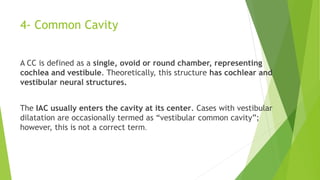 4- Common Cavity
A CC is defined as a single, ovoid or round chamber, representing
cochlea and vestibule. Theoretically, this structure has cochlear and
vestibular neural structures.
The IAC usually enters the cavity at its center. Cases with vestibular
dilatation are occasionally termed as “vestibular common cavity”;
however, this is not a correct term.
 
