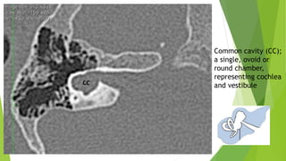Common cavity (CC);
a single, ovoid or
round chamber,
representing cochlea
and vestibule
 