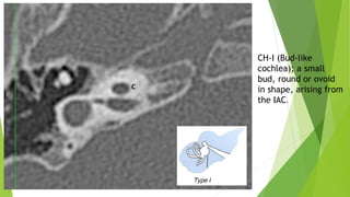 CH-I (Bud-like
cochlea); a small
bud, round or ovoid
in shape, arising from
the IAC.
 
