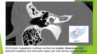CH-II (Cystic hypoplastic cochlea) cochlea has smaller dimensions with
defective modiolus and interscalar septa, but with normal external outline.
 