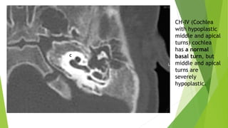 CH-IV (Cochlea
with hypoplastic
middle and apical
turns) cochlea
has a normal
basal turn, but
middle and apical
turns are
severely
hypoplastic.
 
