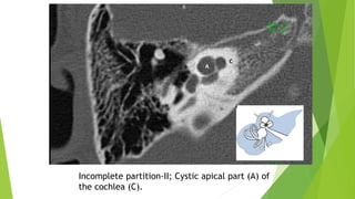 Incomplete partition-II; Cystic apical part (A) of
the cochlea (C).
 
