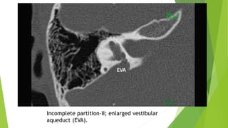 Incomplete partition-II; enlarged vestibular
aqueduct (EVA).
 