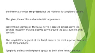 the interscalar septa are present but the modiolus is completely absent.
This gives the cochlea a characteristic appearance.
labyrinthine segment of the facial nerve is located almost above the
cochlea instead of making a gentle curve around the basal turn on axial
sections.
The labyrinthine segment of the facial nerve is the most superior structure
in the temporal bone.
Tympanic and mastoid segments appear to be in their normal position.
 