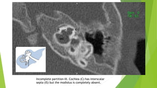 Incomplete partition-III. Cochlea (C) has interscalar
septa (IS) but the modiolus is completely absent.
 