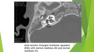 Axial section; Enlarged vestibular aqueduct
(EVA) with normal modiolus (M) and normal
vestibule (V).
 