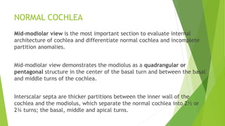 NORMAL COCHLEA
Mid-modiolar view is the most important section to evaluate internal
architecture of cochlea and differentiate normal cochlea and incomplete
partition anomalies.
Mid-modiolar view demonstrates the modiolus as a quadrangular or
pentagonal structure in the center of the basal turn and between the basal
and middle turns of the cochlea.
Interscalar septa are thicker partitions between the inner wall of the
cochlea and the modiolus, which separate the normal cochlea into 2½ or
2¾ turns; the basal, middle and apical turns.
 