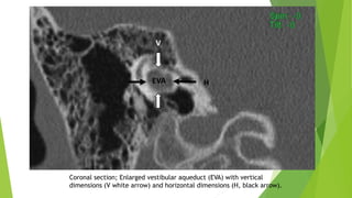 Coronal section; Enlarged vestibular aqueduct (EVA) with vertical
dimensions (V white arrow) and horizontal dimensions (H, black arrow).
 