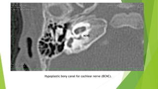 Hypoplastic bony canal for cochlear nerve (BCNC).
 
