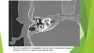 The CA is considered to be aplastic when the canal is completely replaced
by bone or there is no canal on mid-modiolar view
 
