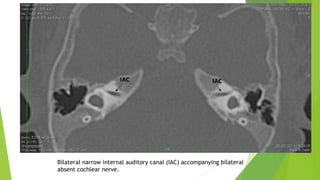 Bilateral narrow internal auditory canal (IAC) accompanying bilateral
absent cochlear nerve.
 