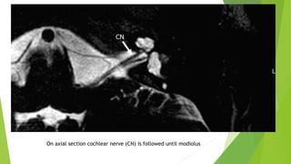 On axial section cochlear nerve (CN) is followed until modiolus
 