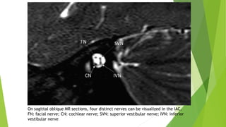 On sagittal oblique MR sections, four distinct nerves can be visualized in the IAC.
FN: facial nerve; CN: cochlear nerve; SVN: superior vestibular nerve; IVN: inferior
vestibular nerve
 