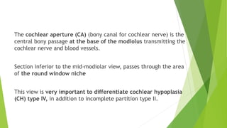 The cochlear aperture (CA) (bony canal for cochlear nerve) is the
central bony passage at the base of the modiolus transmitting the
cochlear nerve and blood vessels.
Section inferior to the mid-modiolar view, passes through the area
of the round window niche
This view is very important to differentiate cochlear hypoplasia
(CH) type IV, in addition to incomplete partition type II.
 