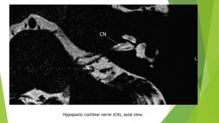 Hypopastic cochlear nerve (CN), axial view.
 