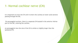 1- Normal cochlear nerve (CN)
It is important to trace the CN until it enters the cochlea on lower axial sections
passing through the IAC.
On parasaggital sections, there is a separate CN located in the anterior inferior
part of the IAC, entering the cochlea.
on parasaggital view the size of the CN is similar or slightly larger than the
ipsilateral FN.
 