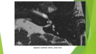 Aplastic cochlear nerve, axial view
 