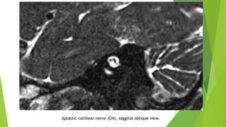 Aplastic cochlear nerve (CN), saggital oblique view.
 